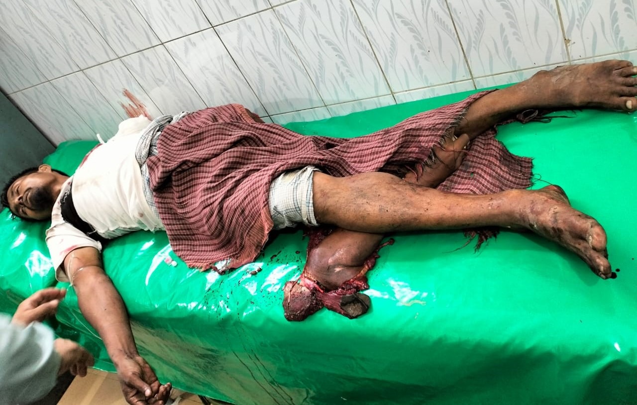 বিরামপুরে চলন্ত ট্রেনে উঠতে গিয়ে পা ফসকে পড়ে ১হাত-পা হারালেন পেয়ারা মাখা বিক্রেতা আশরাফুল বিরামপুরে চলন্ত ট্রেনে উঠতে গিয়ে পা ফসকে পড়ে ১হাত-পা হারালেন পেয়ারা মাখা বিক্রেতা আশরাফুল